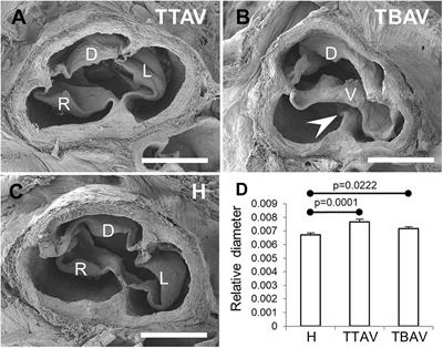 Experimental evidence of the genetic hypothesis on the etiology of bicuspid aortic valve aortopathy in the hamster model